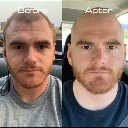 Backly CleanDome™: Turn Baldness Into Boldness In Just 5 Minutes