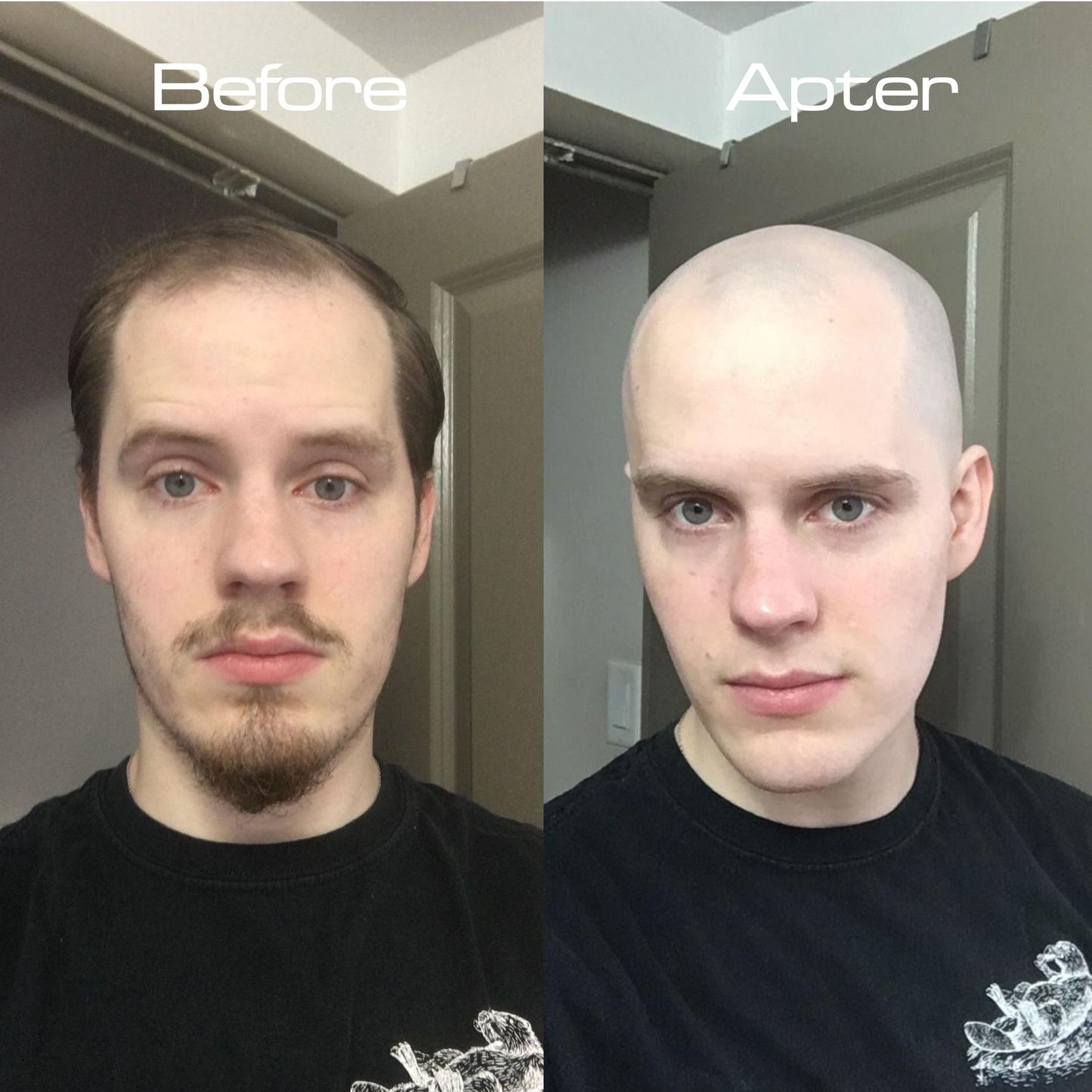 Backly CleanDome™: Turn Baldness Into Boldness In Just 5 Minutes