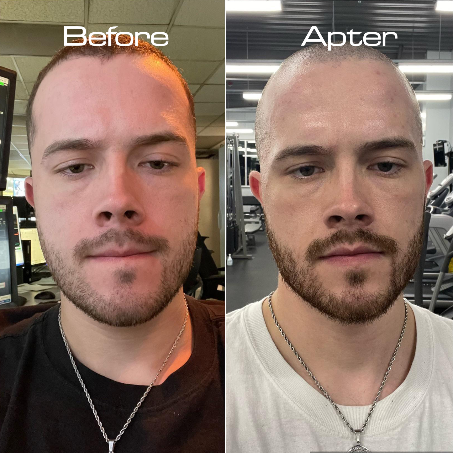 Backly CleanDome™: Turn Baldness Into Boldness In Just 5 Minutes